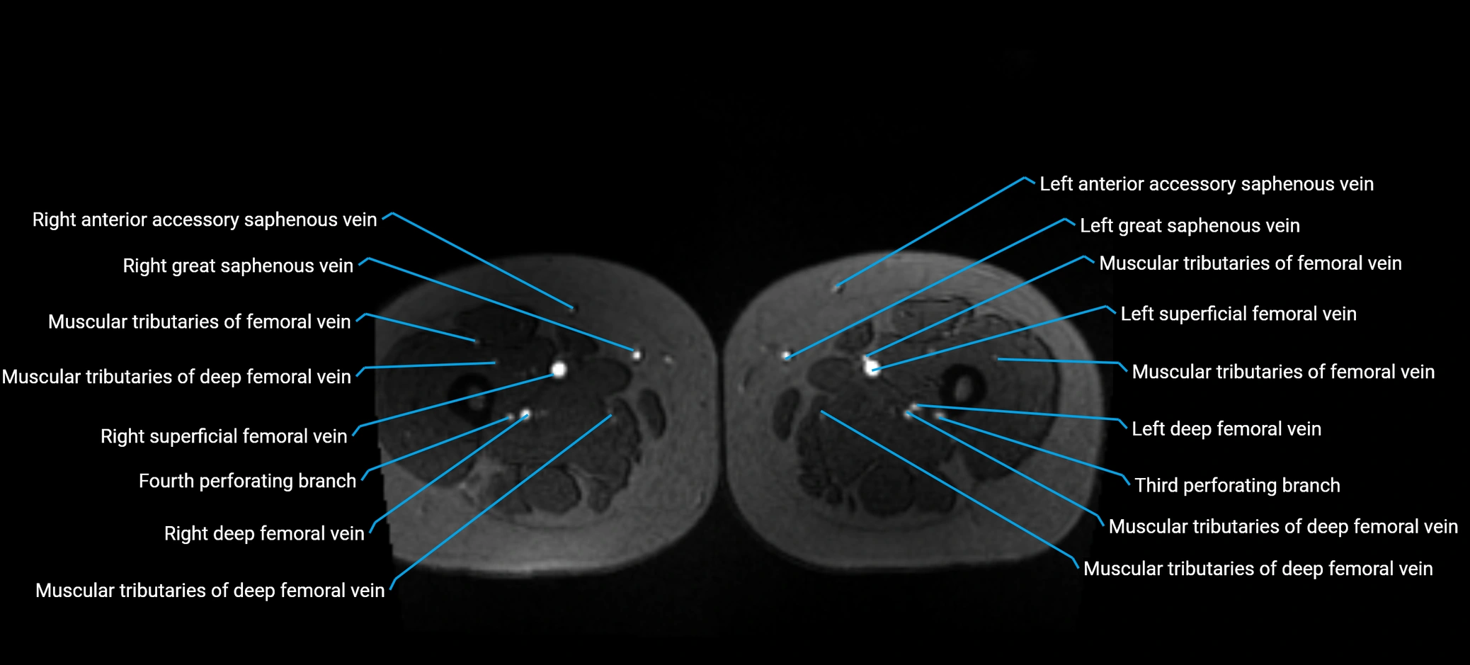 MRV abdomen pelvis & lower limb axial cross sectional anatomy labelled MRI image 251 (1).webp